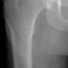 Radiography of the Proximal Femur