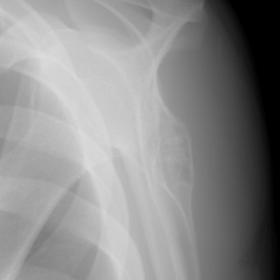 Conventional Radiography of the Scapula