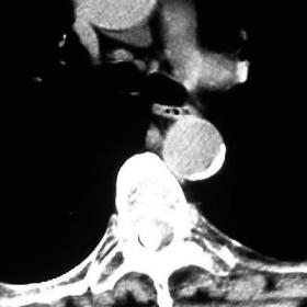 Calcified mass in the spinal canal