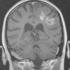 Cerebral MRI