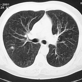 Baseline low-dose CT scan of the chest.
