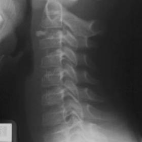 Radiography of the cercival spine