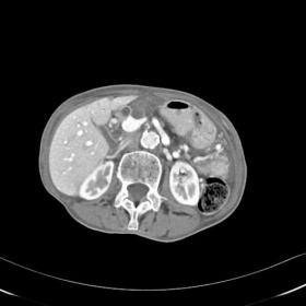 Ct Abdomen with Oral and IV contrast