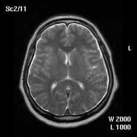 T2-WI, FLAIR and contrast enhanced T1-WI of the brain at initial presentation