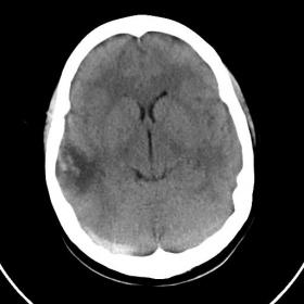 A non-contrast CT image of the head