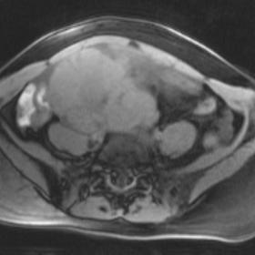 Fat-suppressed T1-weighted  MR Image on axial plane: in right abdominal- pelvic region