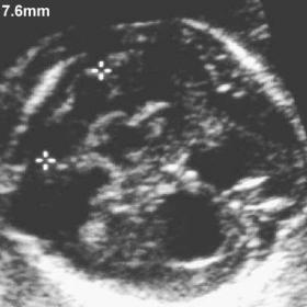 Antenatal USS: Axial sections through the head