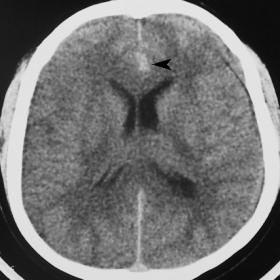 A cerebral, non-enhanced axial computed tomographic image