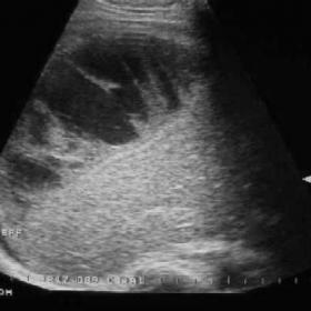 Right upper quadrant sagittal ultrasound