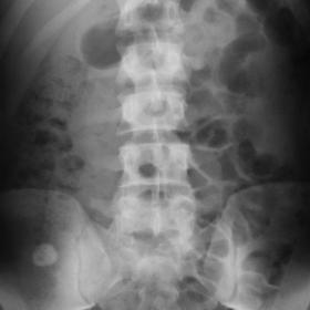 Plain abdominal X-Ray, AP view