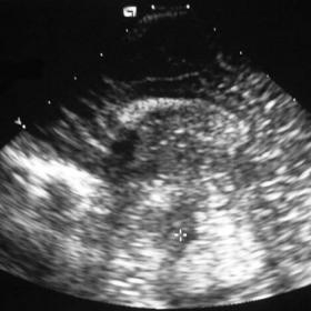 Coronal and sagittal  cranial ultrasound images