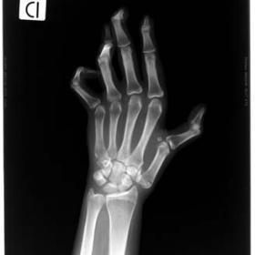 An AP radiograph of the right hand