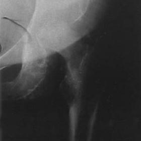An AP radiograph of the Left hip taken two months after the onset of symptoms