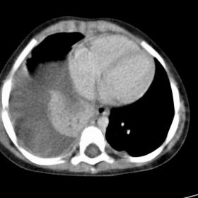Selected CT images of the thorax