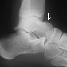A conventional X-ray of the left ankle