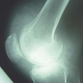 A plain radiograph of the right knee