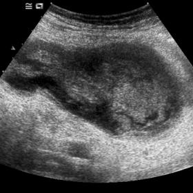 An ultrasonographic image showing the presence of a large cystic mass with a slightly hyperechogenic and heterogeneous content