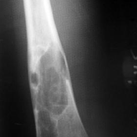 X-ray examination: showed the  lesion  with a pathologic fracture