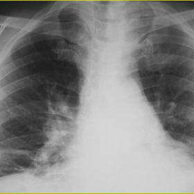 P-A chest x-ray