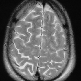 MRI of the brain