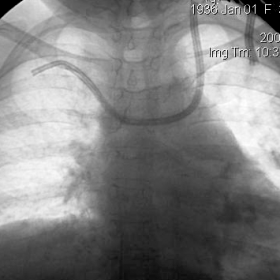 Figure 1. Digital chest radiograph depicts the misplaced central venous catheter with its tip into the right subclavian vein.