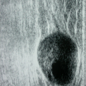 Ultrasonography shows an elongated ovoid mass of 2 cm, with double structure, tissular and cystic.  The tumor is eccentric to the nerve trunk of origin
