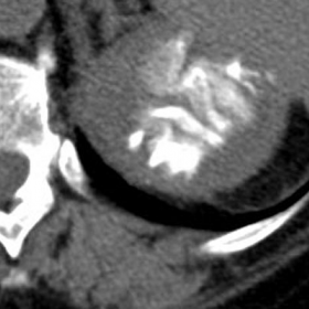 Fig.1: Unenhanced CT appearance of the renal mass