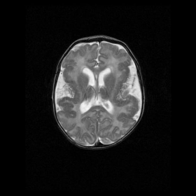 Axial T2W MR brain