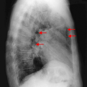 Lateral chest x-ray shows linear streaks of translucency around pulmonary arteries, pulmonar hila, aortic arch (red arrows).