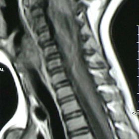 Figure 1:Craniovertebral junction MRI