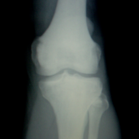 AP knee radiograph