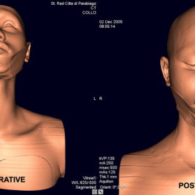 V.R. surface pre- and post-operative reconstruction.