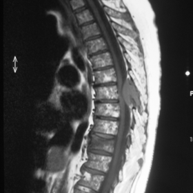 T1-weighted sagittal image. Isointense soft tissue mass involving the spinous process of D6, and extending into the spinal canal, with mass-like effect.