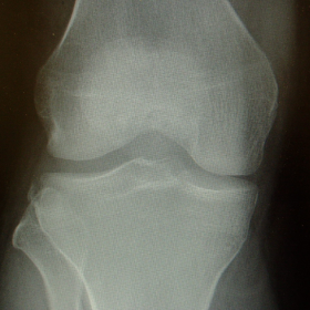 AP view of knee