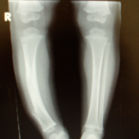 AP view of both tibia