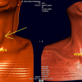 V.R. surface reconstructions showing pre-operative right paramedian swelling of the mid-inferior levels of the neck and post-operative restitutio ad integrum.