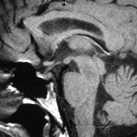 Sagittal T1-weighted MR image of pituitary fossa.