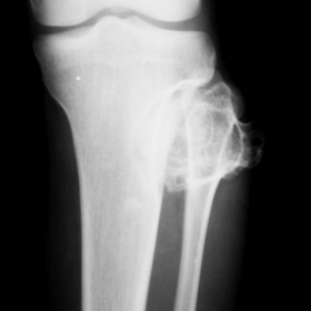 Plain AP-film shows the bony lesion arising from the fibular head. Note that the lesion has sharp and discriminate borders, and is in contiuity with the host bone.