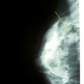 Right oblique mammogram