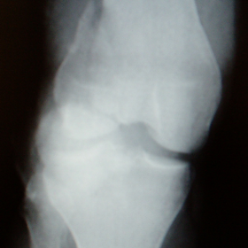AP view of the knee