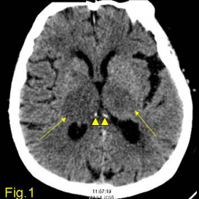 Axial NECT shows hypodensity of both thalami (arrows) and increased density in internal cerebral veins (arrowheads)