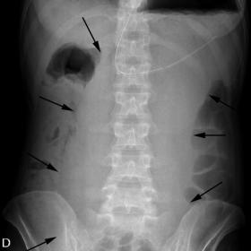 Plain film of abdomen shows a huge gastric dilatation (arrows).