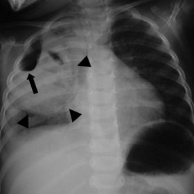 Fig. 1. Conventional  ap chest roentgenogram. Round shaped and well demarcated pulmonary mass (arrowheads) with gas fluid levels (arrow).