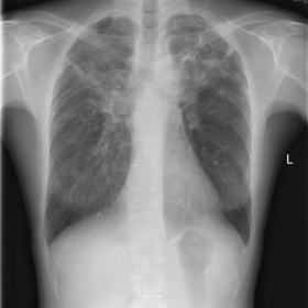 Chest Radiograph 2003
