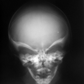 Skull Radiograph and 3D CT scan