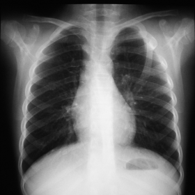 Frontal chest radiograph.
