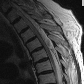Sagittal T2-weighted MR image, of throracic spine.