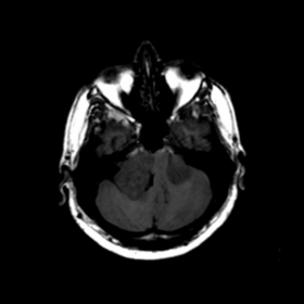 Axial T1-weighted image of the brain without contrast: