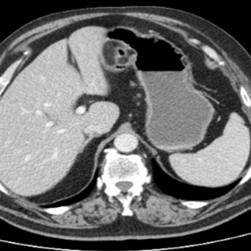 Abdominal CT  (supine scan)