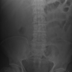 Abdominal X-ray on admission